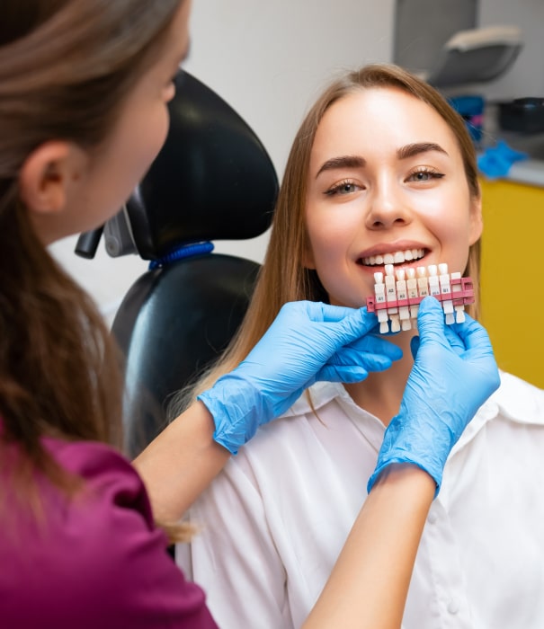 composite veneers top min
