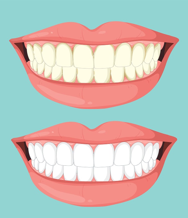 benefits of in chair teeth whitening min