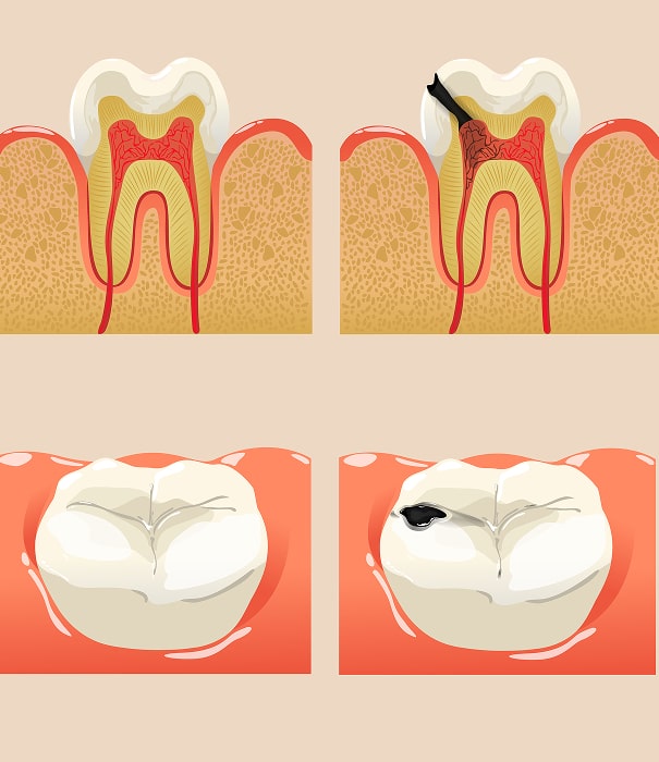 candidate for dental fillings min