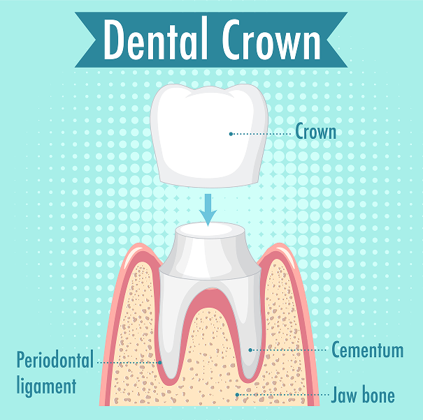dental crown new image