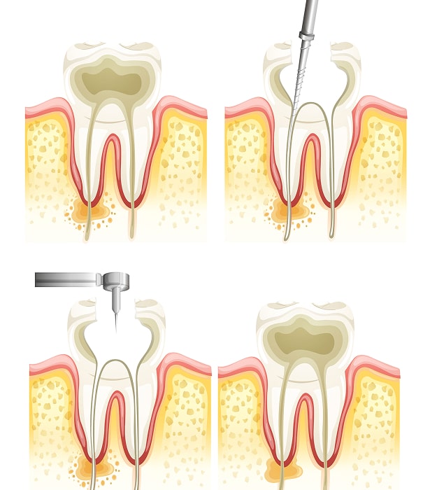 key benefits of root canal min