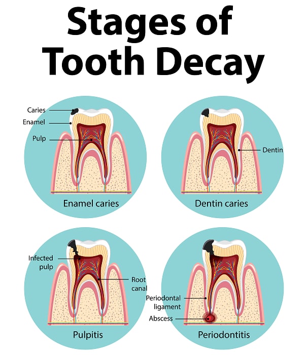 stages of tooth decay min
