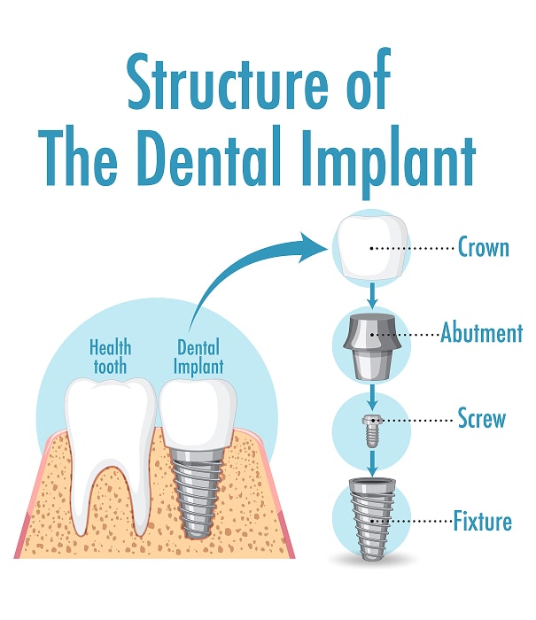 structure of dental implant min min