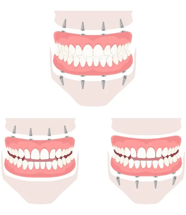 Benefits of All on 4 Dental Implants