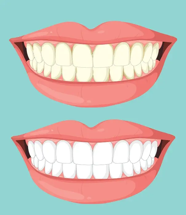 Benefits of Choosing In Chair Teeth Whitening Treatment