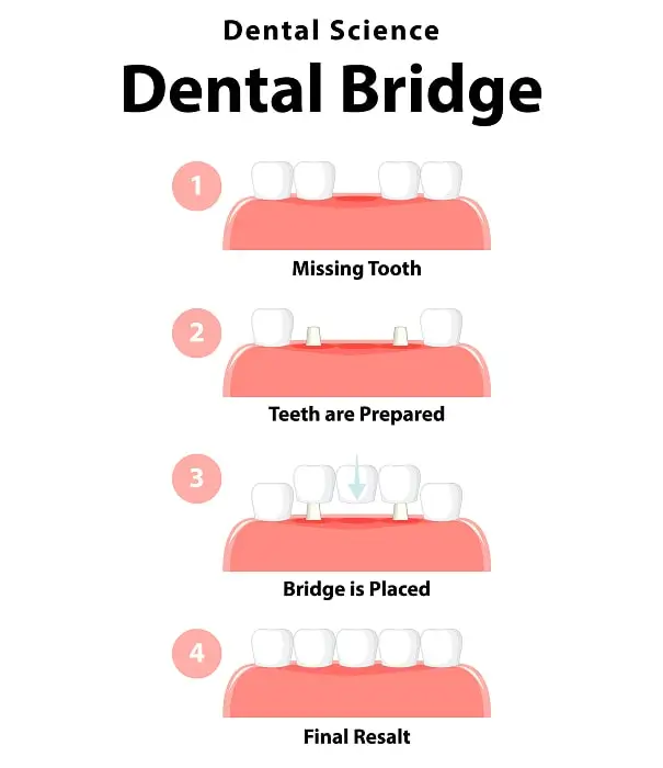 Full Benefits of a Dental Bridge Treatment