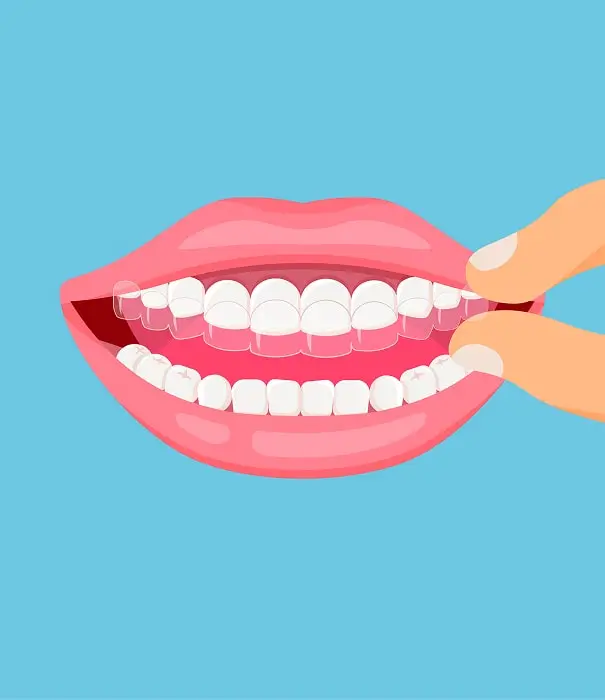 Invisalign is the Preferred Choice for Many Patients
