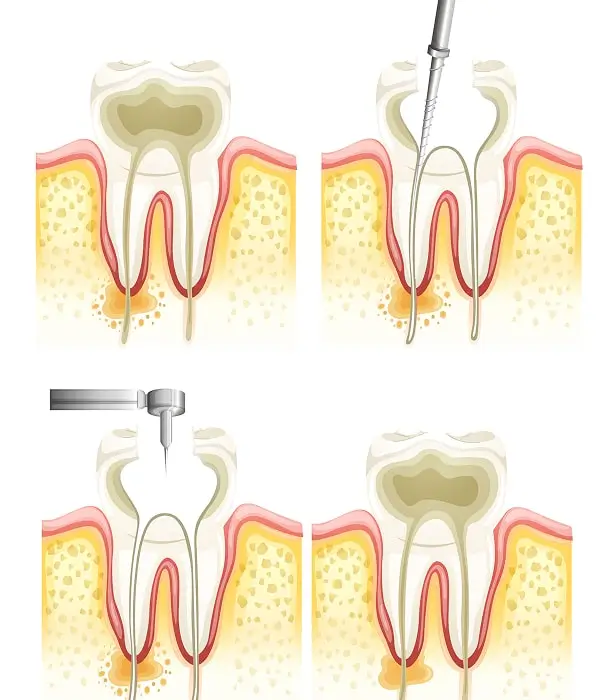 Root Canal Therapy for Lasting Tooth Health