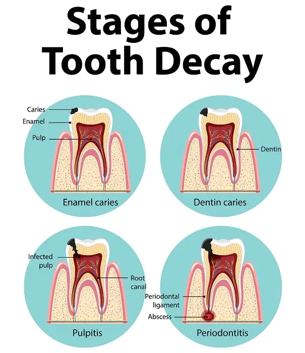Suitable Candidates for Tooth Extractions