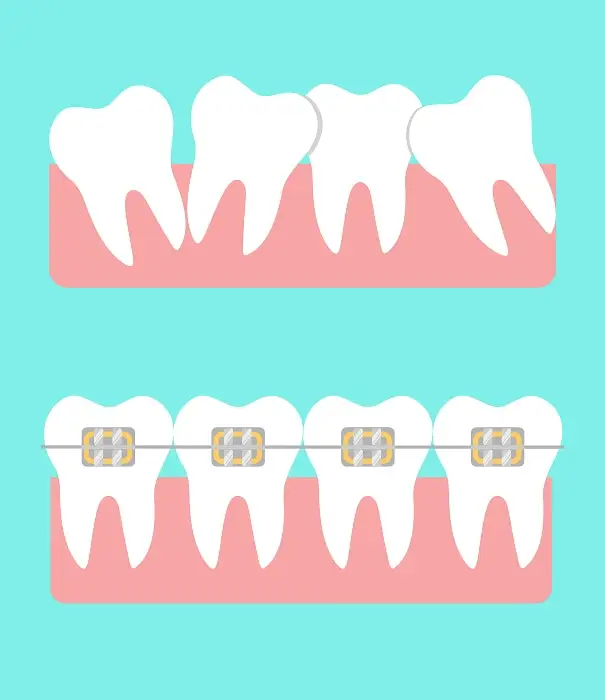 Traditional Braces for Achieving Proper Tooth Alignment