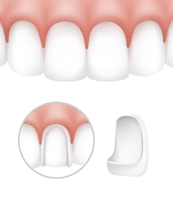 Veneer Benefits