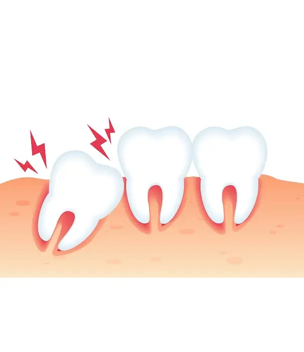 Wisdom Teeth Removal