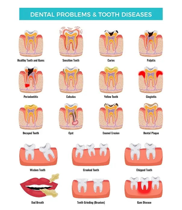 Why Lost Crowns and Fillings Replacement Matters for Lasting Oral Health
