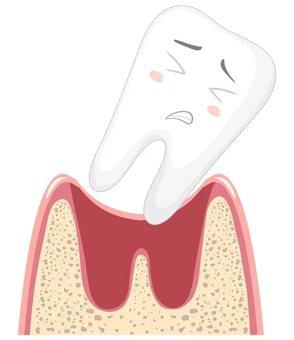 When to Act on an Avulsed Tooth Emergency