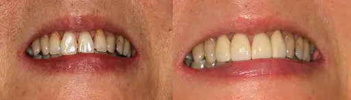 Before and after smile comparison showing cosmetic dental treatment