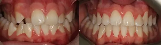 Before and after smile comparison showing orthodontic treatment
