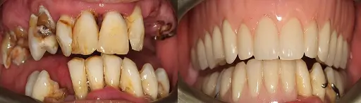 Before and after smile comparison showing restorative dental treatment