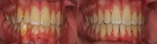 Before and after smile comparison showing teeth alignment treatment