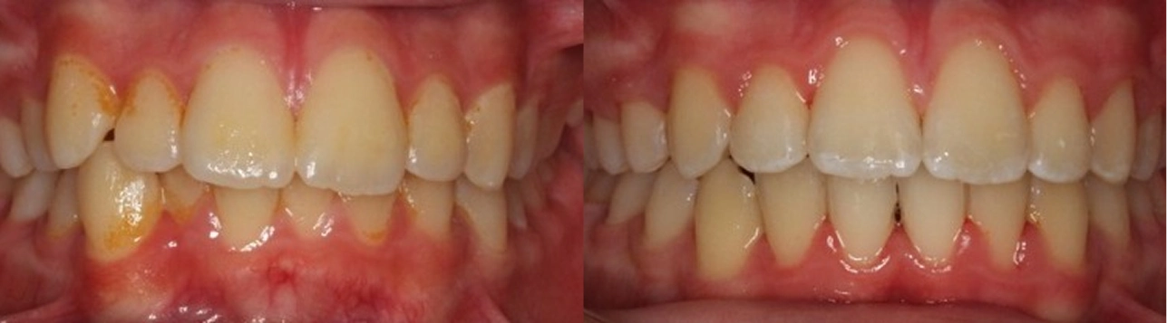Before and after views of front teeth