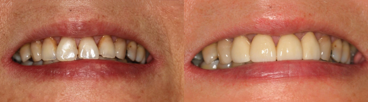Side-by-side comparison of teeth following cosmetic treatment.