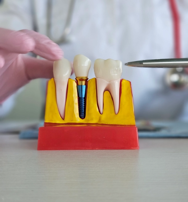 Hand pointing with a pen to a dental cross-section model showing a titanium screw implant between two teeth