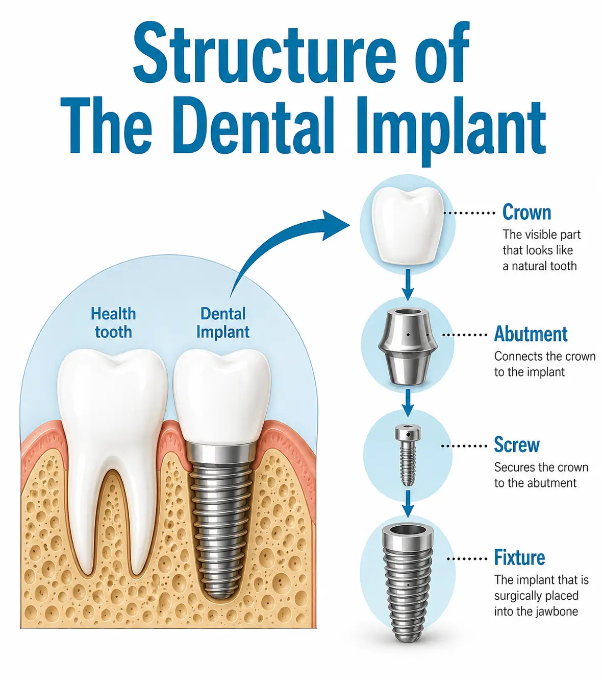 Illustration showing the structure of a dental implant, including the crown, abutment, screw and implant fixture
