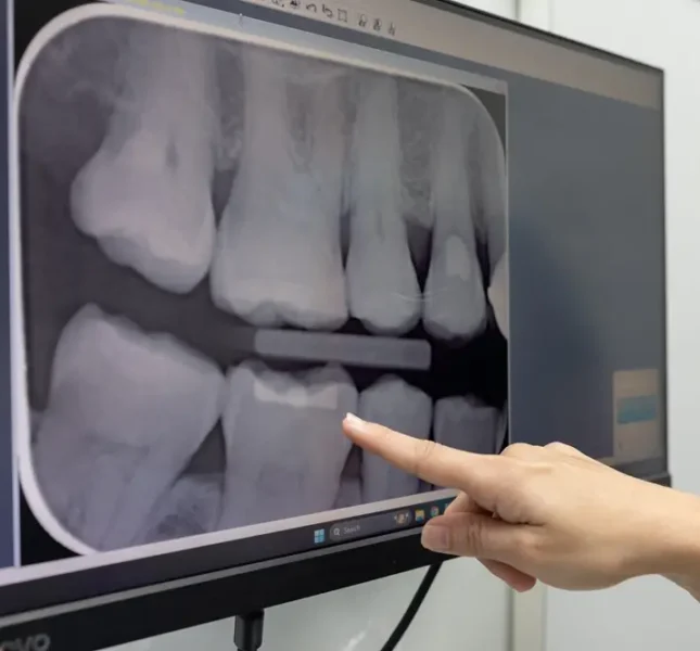 Hand pointing to a dental X-ray displayed on a monitor