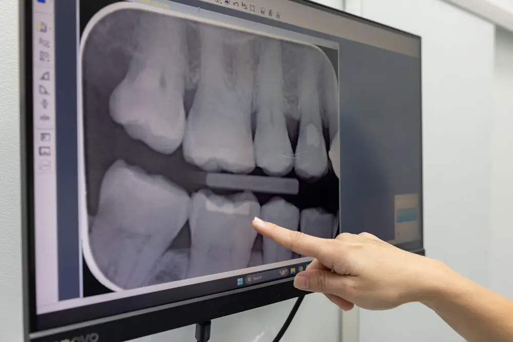 Hand pointing to a dental X-ray displayed on a monitor