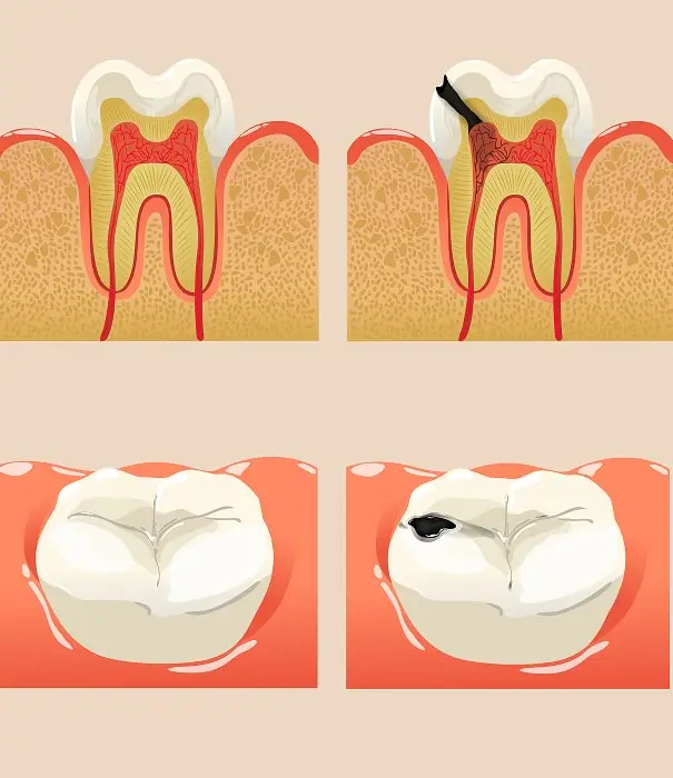 healthy vs decayed teeth dental fillings