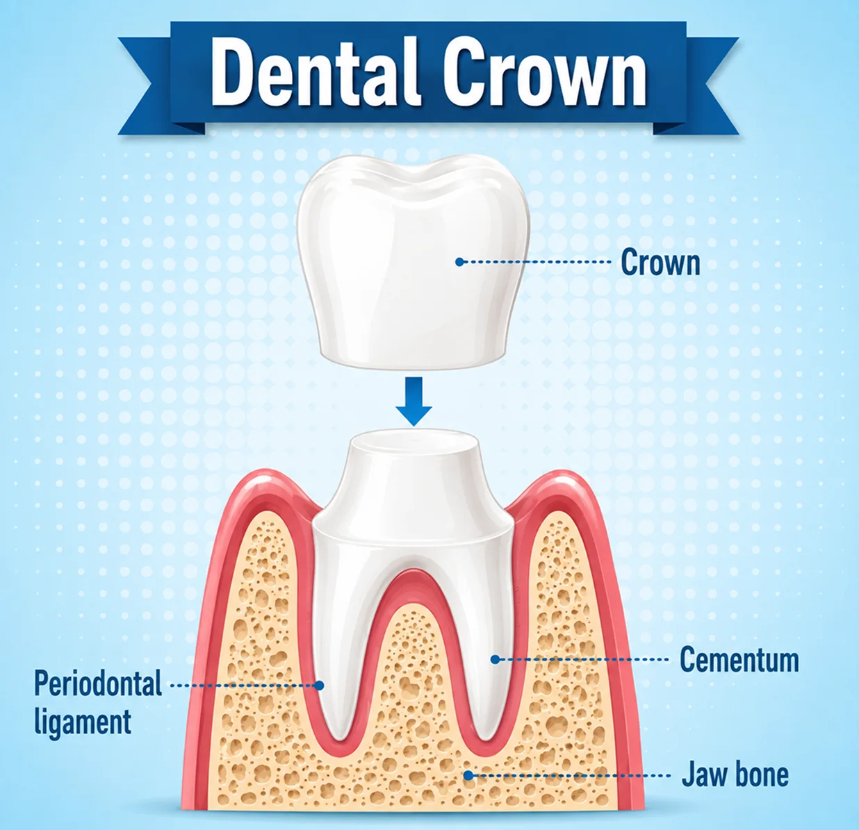 Diagram titled Dental Crown showing a crown fitting over a prepared tooth root, labeled with Cementum, Jaw bone, and Periodontal ligament