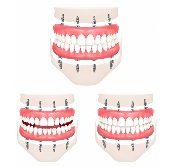 illustration full arch dental implant diagrams