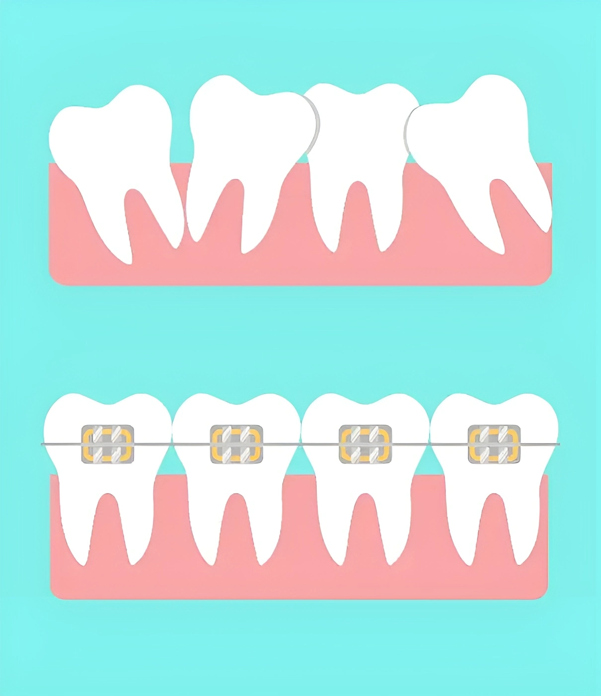 Illustration comparing crooked teeth above to straight teeth with dental braces below