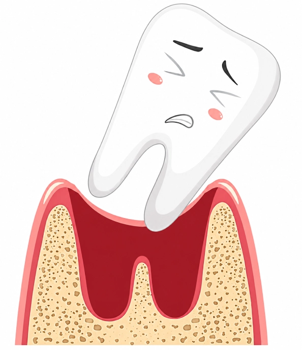 Illustration of an impacted wisdom tooth pressing against the gum.