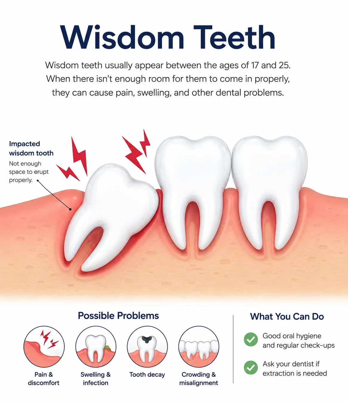 Illustration showing an impacted wisdom tooth causing pain and requiring removal