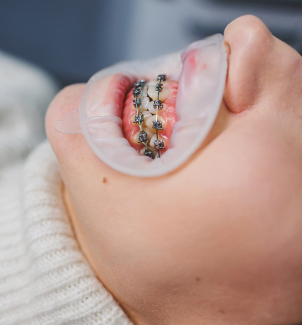 Macro view of a patient’s teeth with a lip retractor and traditional metal braces showing gum inflammation