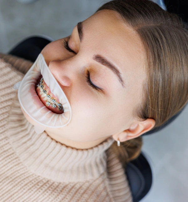 High-angle close-up of a patient lying down with a lip retractor and metal braces