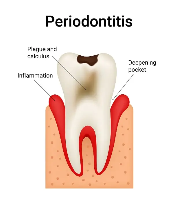 Illustration showing periodontitis with plaque buildup, gum inflammation, and deep periodontal pockets