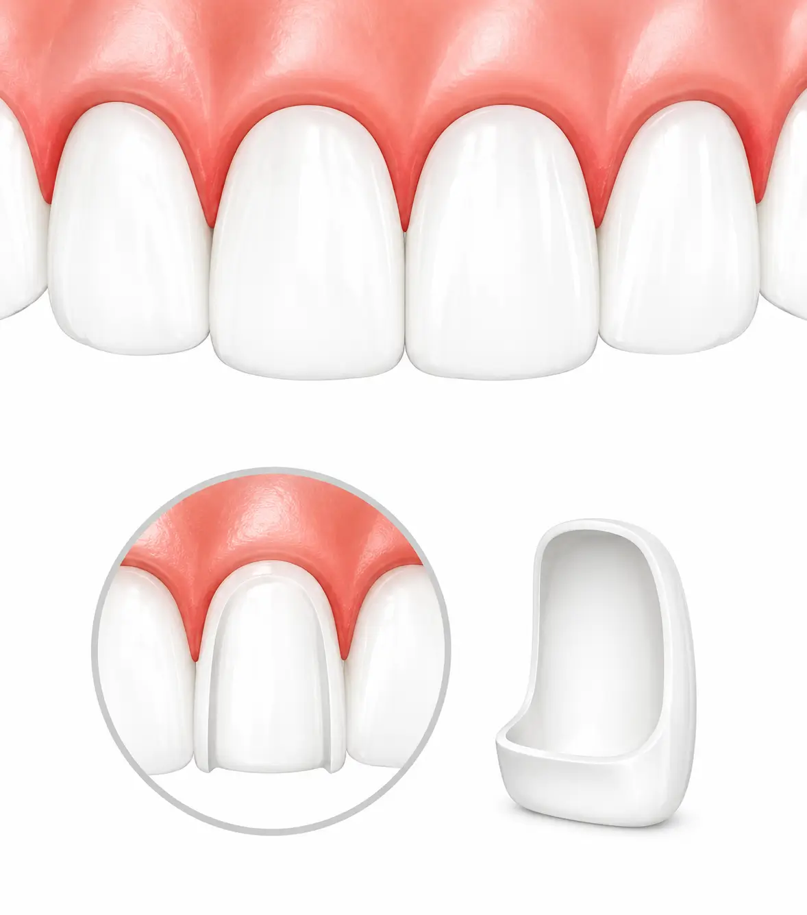 Diagram showing a porcelain veneer placed over a prepared tooth