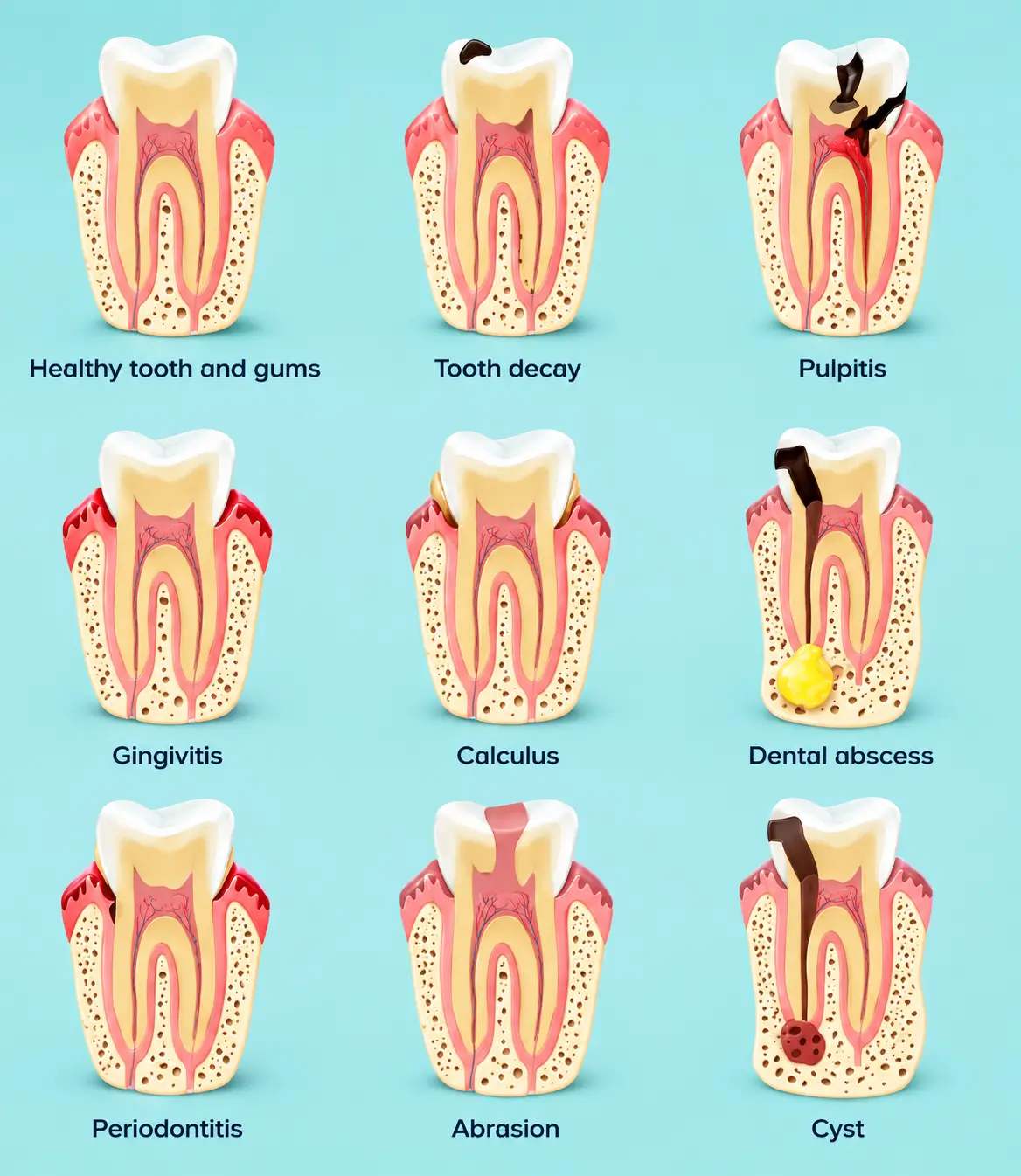 Illustration showing stages of tooth decay and common dental conditions including healthy teeth, pulpitis, gingivitis, abscess, periodontitis and cyst