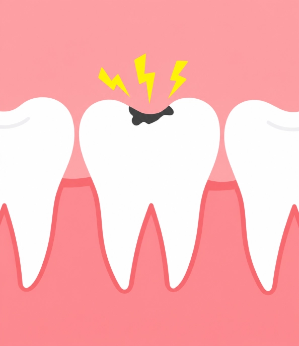 tooth with visible decay illustration