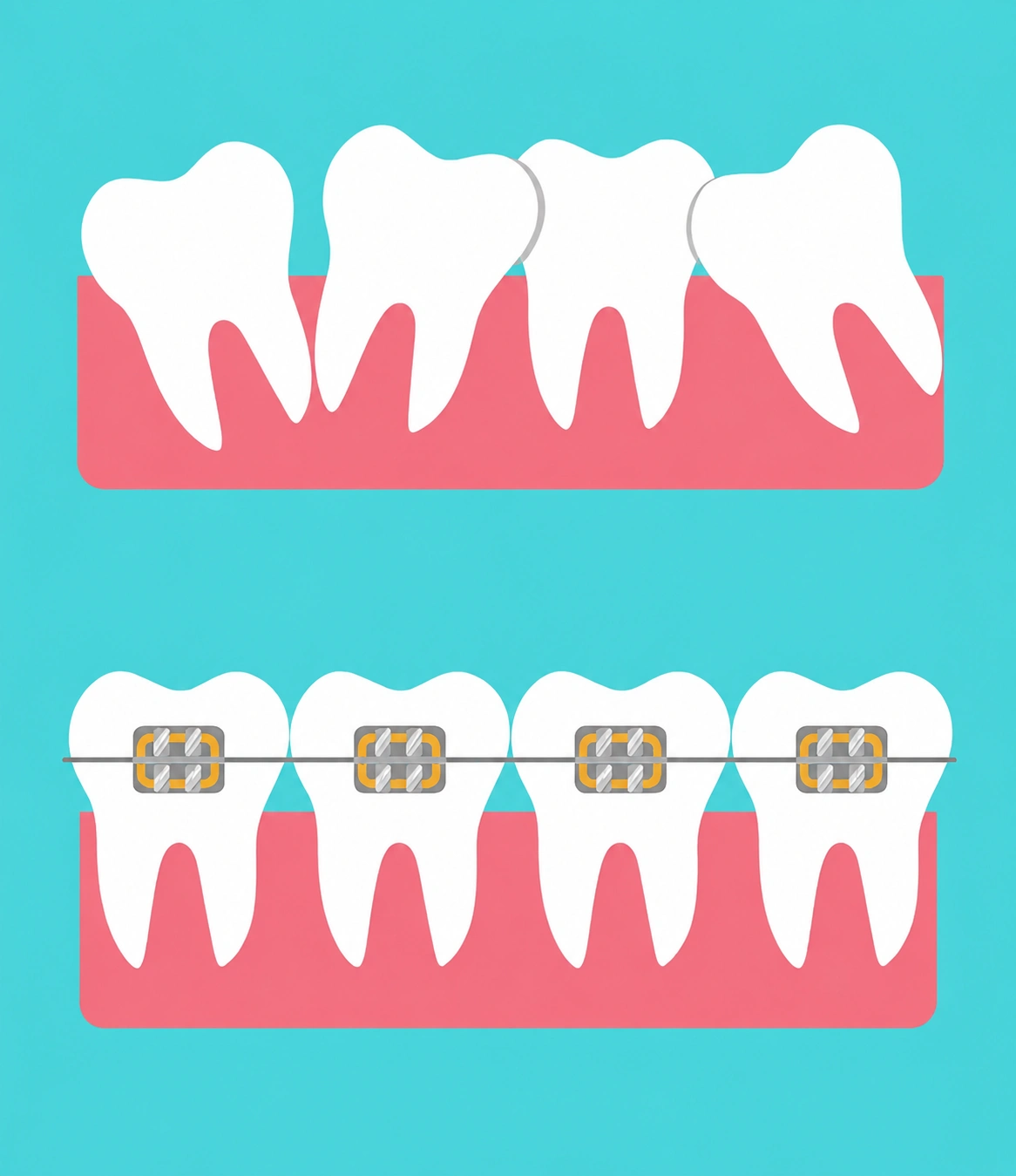 Illustration comparing misaligned teeth with teeth straightened using traditional braces