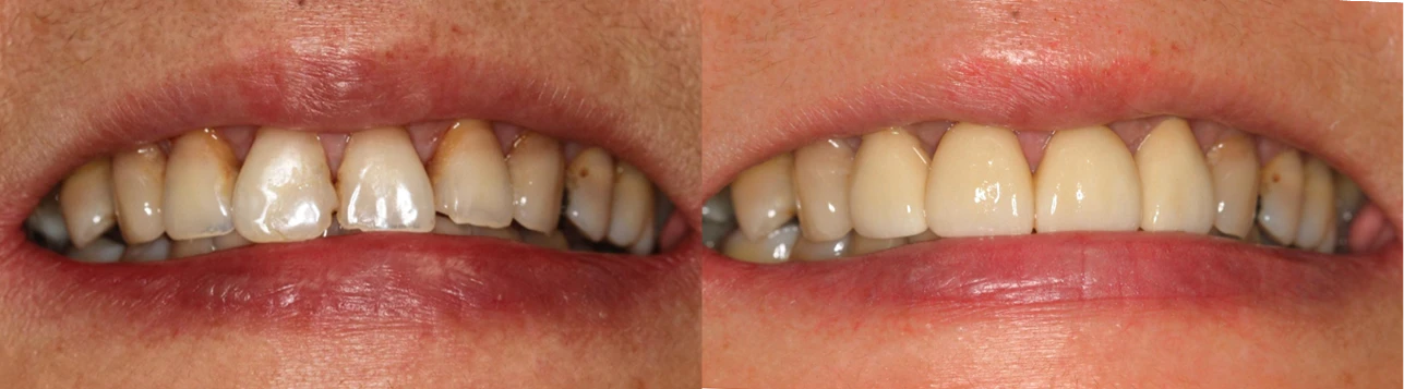 side by side teeth colour appearance
