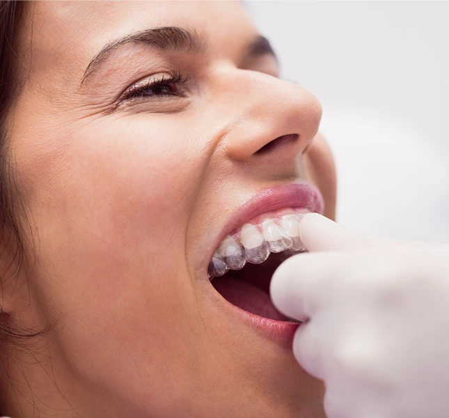 transparent dental aligner upper teeth