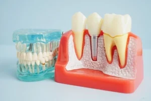 is dental implant safe check is dental implant safe check