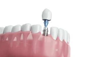 photo showing regeneration of jawbone volume with a dental implant placed in the improved site photo showing regeneration of jawbone volume with a dental implant placed in the improved site
